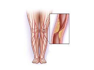 Cardiology disease