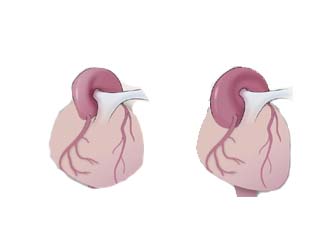 Cardiology disease