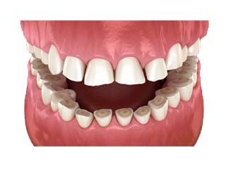 Clenching or Grinding Your Teeth