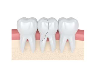 Cracked Tooth