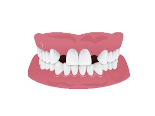 Gap Between Teeth