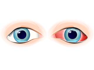 Uveitis
