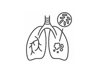 Tuberculosis