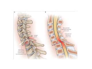 Spine Surgery